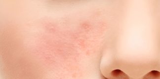 Skin barrier rusak