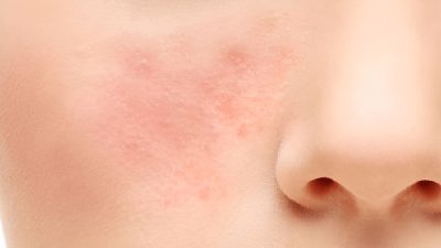 Skin barrier rusak