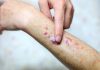 Tips mencegah leukemia