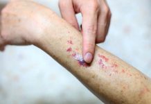 Tips mencegah leukemia
