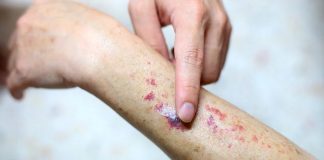 Tips mencegah leukemia