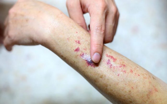 Tips mencegah leukemia