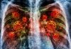 Tips mencegah pneumonia