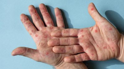 Tips mengatasi campak