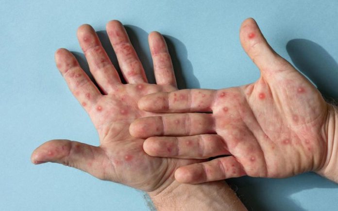 campak-anak Tips mengatasi campak